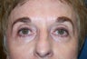 Pearl Fractional Laser