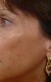 Pearl Laser Treatment
