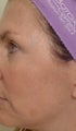 Pearl Laser Treatment