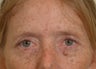 Pearl Laser Treatment