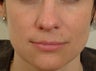 Pearl Laser Treatment