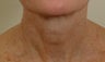 Pearl Laser Treatment