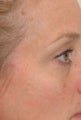 Pearl Laser Treatment
