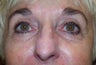 Pearl Fractional Laser