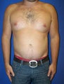 Pec Implants