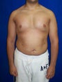 Pec Implants