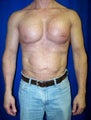 Pec Implants