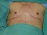 Chest Wall Reconstruction Surgery