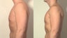 Pectoral implants
