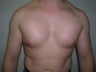 Pec Implants