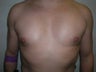 Pec Implants