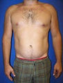 Pec Implants