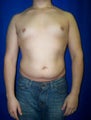 Pec Implants