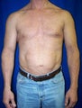Pec Implants