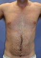 Pectoral Implants