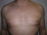 Pec Implants