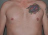 Pec Implants