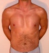 Male Chest Enhancement