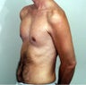 Male Chest Enhancement