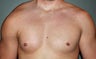 Pectoral Implants