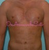 Pectoral Implants for Men