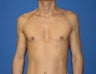 Pectoral Implants, Chest Augmentation