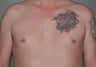 Pec Implants