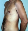 Male Chest Enhancement