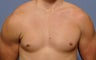 Pectoral Implants