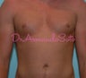 Pectoral Implants for Men