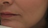Nasolabial folds and Marionette lines after treatment with Perlane