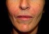 Perlane in the Nasolabial Folds