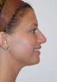 Non-Surgical Nosejob