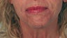 Perlane Treatment for laugh lines
