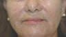 Perlane and Botox for mouth lines