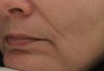 Nasolabial folds and Marionette lines after treatment with Perlane