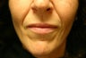 Perlane in the Nasolabial Folds