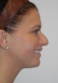 Non-Surgical Nosejob