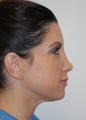 Non-Surgical Nose job