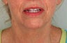 Perlane Treatment for laugh lines