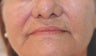 Perlane and Botox for mouth lines
