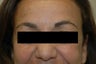 Permanent Makeup Removal Los Angeles Before and After Pictures