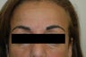Permanent Makeup Removal Los Angeles Before and After Pictures