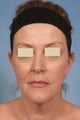 Phenol Peel