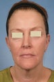Phenol Peel