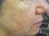 Severe Acne