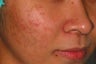PDT for acne