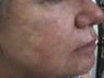 Severe Acne
