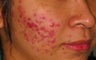 PDT for acne