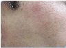 Photofacial/IPL